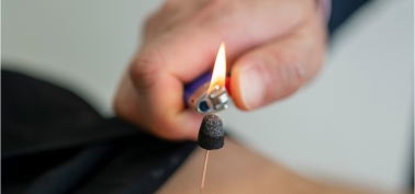 Moxibustion new picture